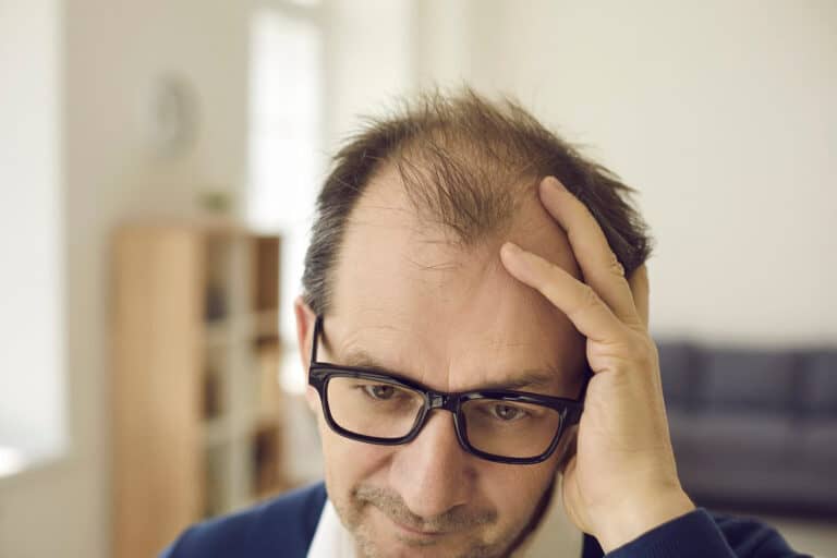 How to Stop Worrying About Hair Loss